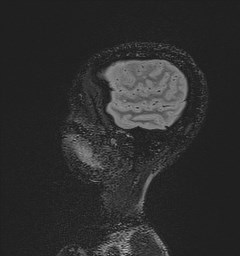 Central neurocytoma (Radiopaedia 84497-99872 Sagittal Flair + Gd 27).jpg