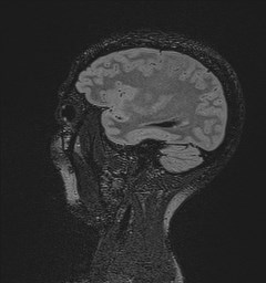 Central neurocytoma (Radiopaedia 84497-99872 Sagittal Flair + Gd 42).jpg