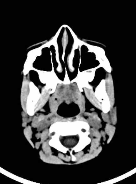 Cerebellar abscess (Radiopaedia 73727-84527 Axial non-contrast 12).jpg