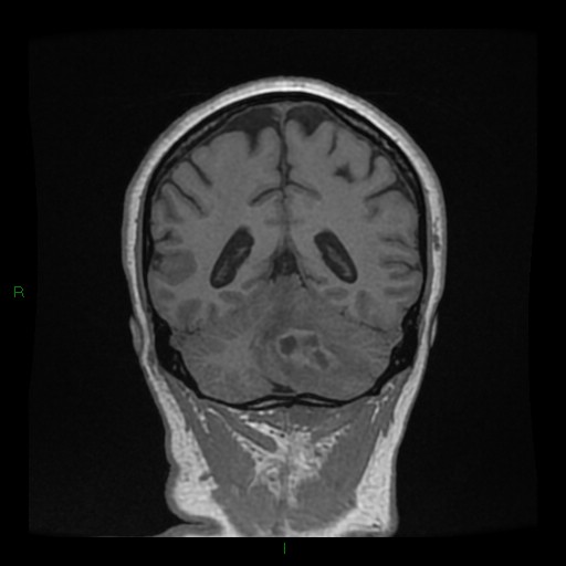 Cerebellar abscess (Radiopaedia 78135-90678 Coronal T1 C+ 116).jpg
