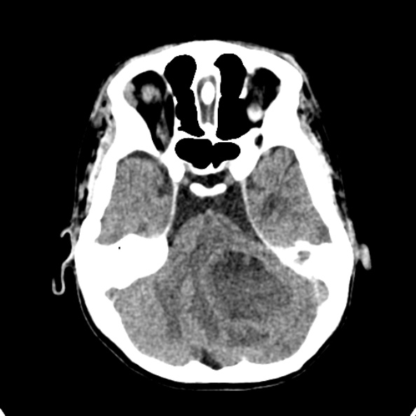 File:Cerebellar abscess secondary to mastoiditis (Radiopaedia 26284-26412 Axial non-contrast 43).jpg