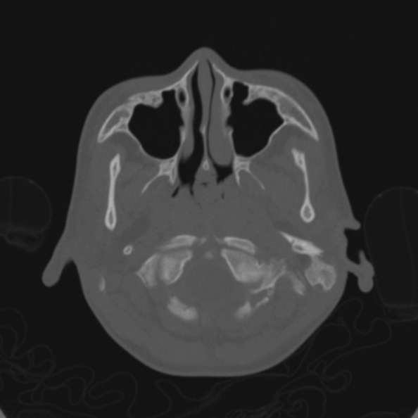 Cerebellar abscess secondary to mastoiditis (Radiopaedia 26284-26413 Axial bone window 15).jpg