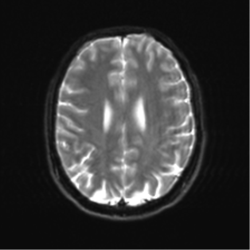 Cerebellar agenesis with hypoplastic pons (pontocerebellar hypoplasia) (Radiopaedia 57224-64138 Axial DWI 26).png