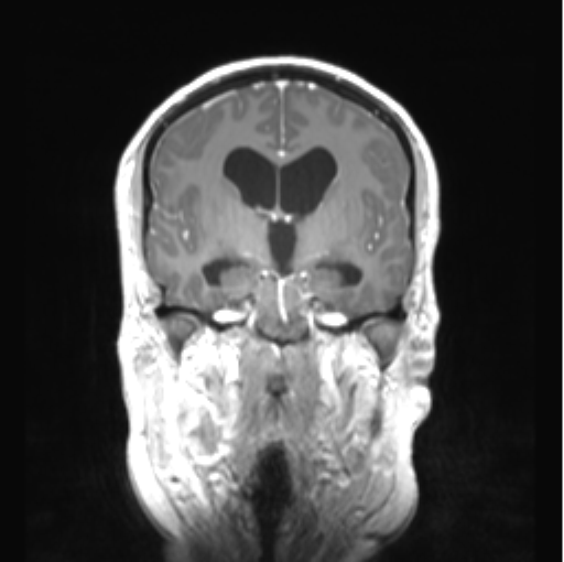 Cerebellar ependymoma complicated by post-operative subdural hematoma (Radiopaedia 83322-97736 Coronal T1 C+ 26).png