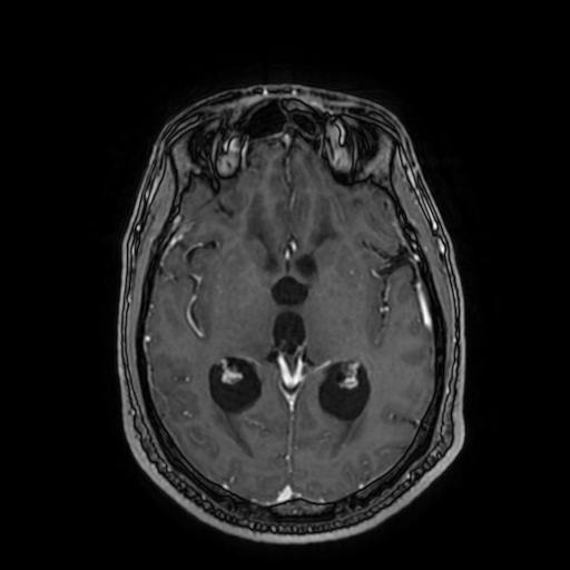 Cerebellar hemangioblastoma (Radiopaedia 88055-104622 Axial T1 C+ 94).jpg