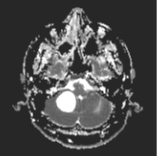 File:Cerebellar hemangioblastomas and pituitary adenoma (Radiopaedia 85490-101176 Axial ADC 7).png