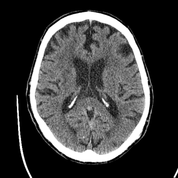 Cerebellar hemorrhage (Radiopaedia 27193-27359 Axial non-contrast 29).jpg
