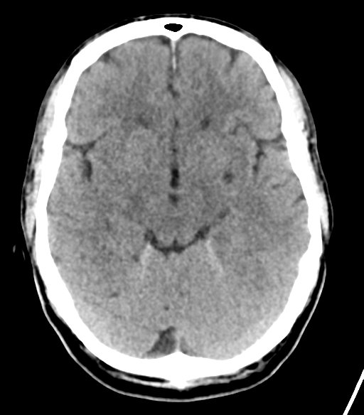 File:Cerebellar hemorrhage (Radiopaedia 37000-38669 Axial non-contrast 17).png