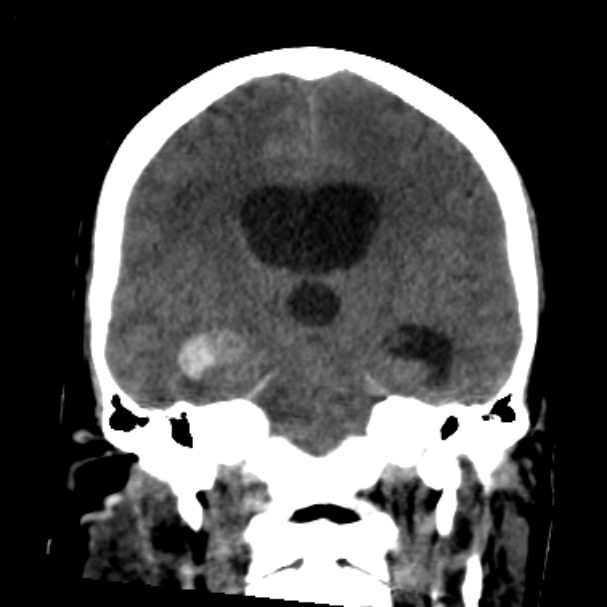 Cerebellar hemorrhage causing obstructive hydrocephalus (Radiopaedia 33989-35207 Coronal non-contrast 29).jpg
