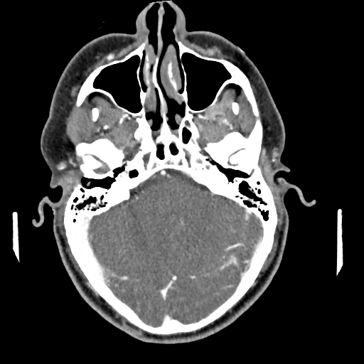 Cerebellar infarct due to vertebral artery dissection with posterior fossa decompression (Radiopaedia 82779-97029 C 18).png
