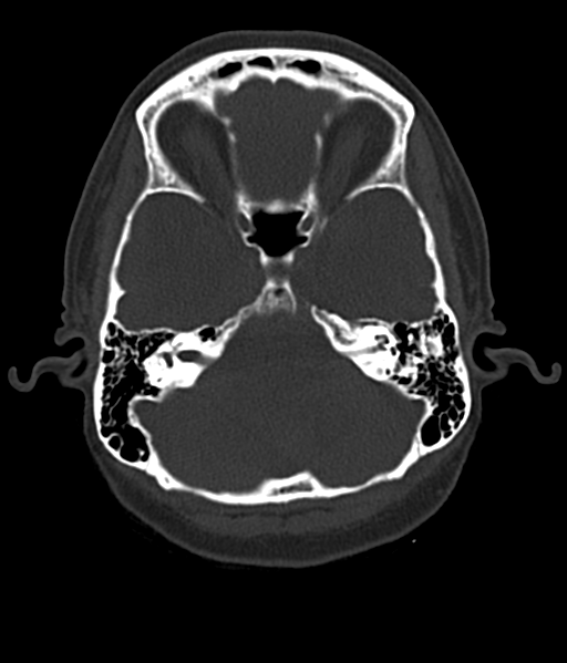 Cerebellar metastases - colorectal adenocarcinoma (Radiopaedia 40947-43652 AX Bone C- 2.0 MPR 13).png