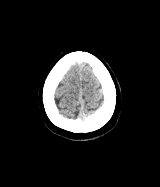 Cerebellar metastases - colorectal adenocarcinoma (Radiopaedia 40947-43652 Axial non-contrast 62).png