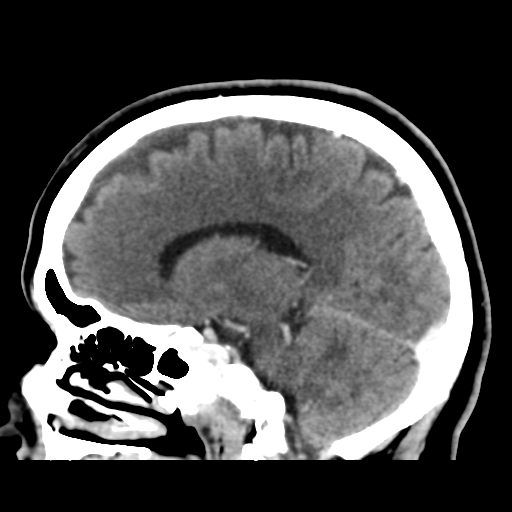 Cerebellar metastasis (cystic appearance) (Radiopaedia 41395-44258 F 23).png