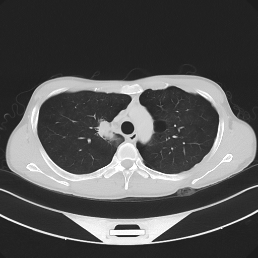 Cerebellar metastasis - adenocarcinoma lung (Radiopaedia 63184-71717 Axial lung window 22).png