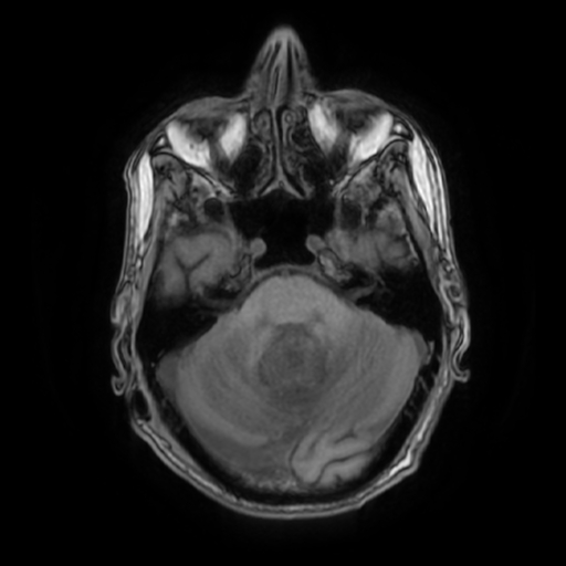 File:Cerebellar metastasis - lung tumor (Radiopaedia 69317-79147 Axial T1 12).jpg