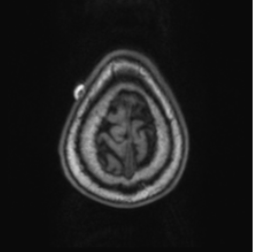 Cerebellar metastasis from lung adenocarcinoma (Radiopaedia 86690-102829 Axial T1 74).png