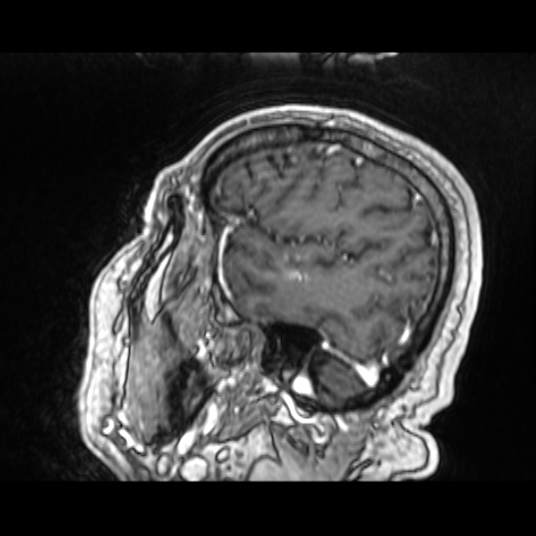 Cerebellar metastasis of pulmonary adenocarcinoma, cavernous venous malformation, and developmental venous anomaly (Radiopaedia 85827-101661 Sagittal T1 C+ 75).jpg