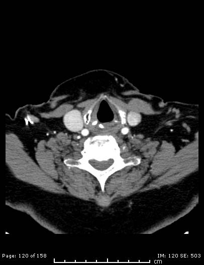 File:Cerebellar strokes due to intracranial giant cell arteritis (Radiopaedia 68799-78510 CT angiogram 120).jpg
