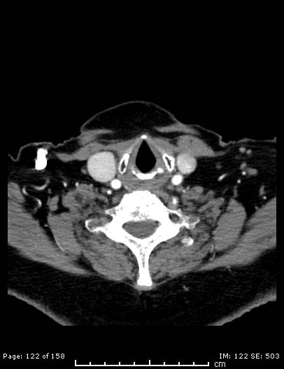 File:Cerebellar strokes due to intracranial giant cell arteritis (Radiopaedia 68799-78510 CT angiogram 122).jpg