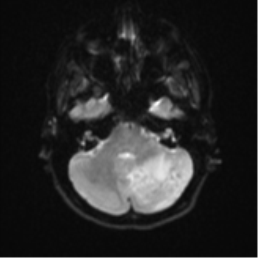 Cerebellar tuberculomas (Radiopaedia 46939-51472 Axial DWI 7).png