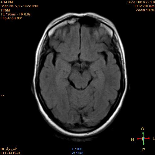 File:Cerebellopontine angle meningioma (Radiopaedia 22488-22525 Axial FLAIR 6).jpg