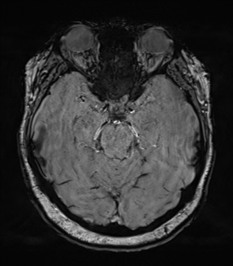 Cerebellopontine angle meningioma (Radiopaedia 48434-53348 Axial SWI 34).png