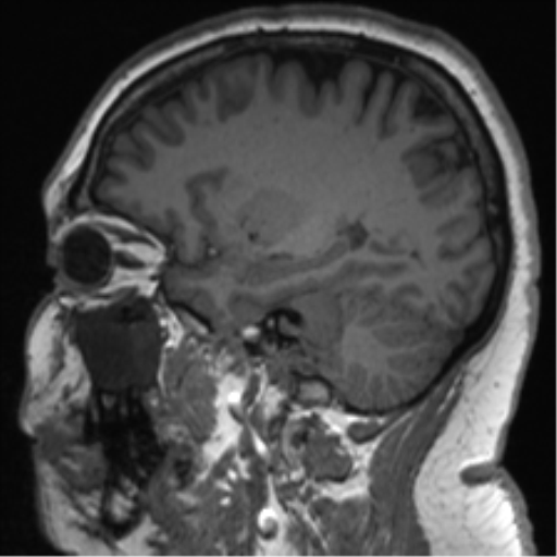 Cerebellopontine angle meningioma (Radiopaedia 48434-53348 Sagittal T1 33).png