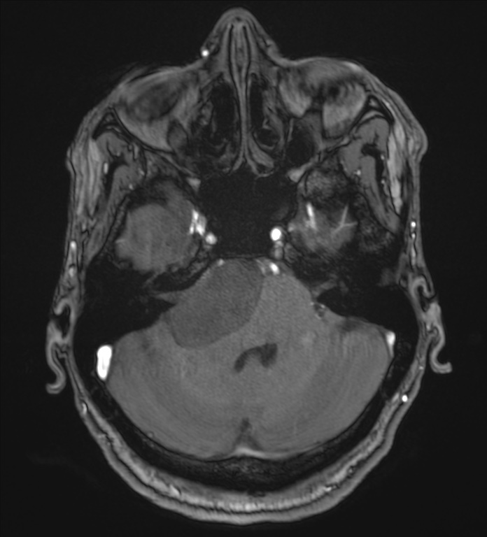 Cerebellopontine angle meningioma (Radiopaedia 72983-83680 Axial MRA 28).jpg