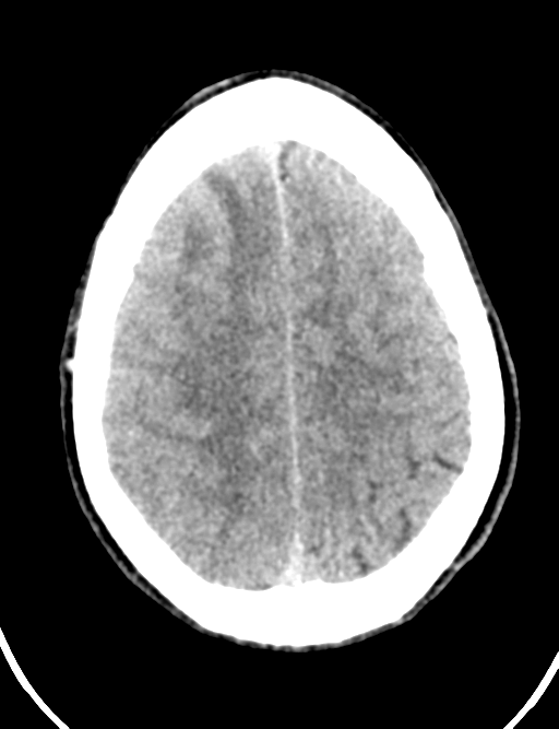 Cerebral abscess (Radiopaedia 60342-68008 Axial non-contrast 41).png