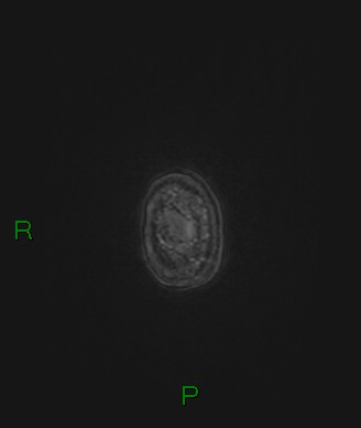 File:Cerebral abscess and subdural empyema (Radiopaedia 84436-99779 Axial FLAIR 4).jpg