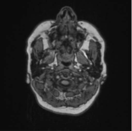 Cerebral abscess from pulmonary arteriovenous malformation (Radiopaedia 86275-102291 Axial T1 1).png