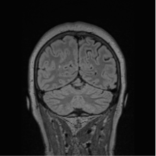 Cerebral abscess from pulmonary arteriovenous malformation (Radiopaedia 86275-102291 Coronal FLAIR 24).png