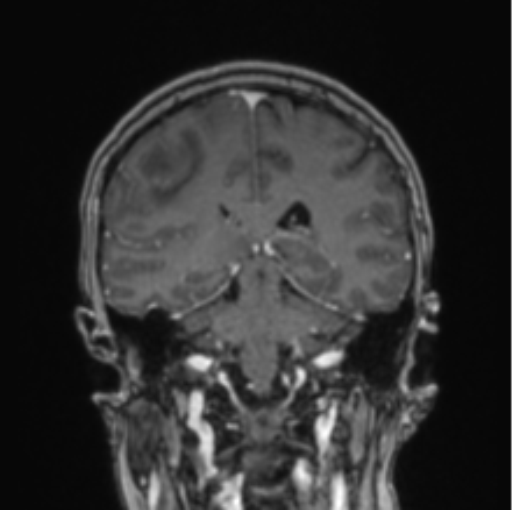 Cerebral abscess from pulmonary arteriovenous malformation (Radiopaedia 86275-102291 L 38).png