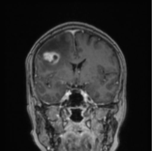 File:Cerebral abscess from pulmonary arteriovenous malformation (Radiopaedia 86275-102291 L 53).png