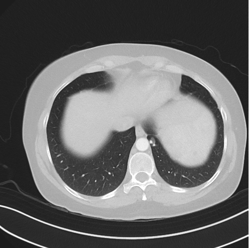 Cerebral abscess from pulmonary arteriovenous malformation (Radiopaedia 86275-102292 Axial lung window 47).png