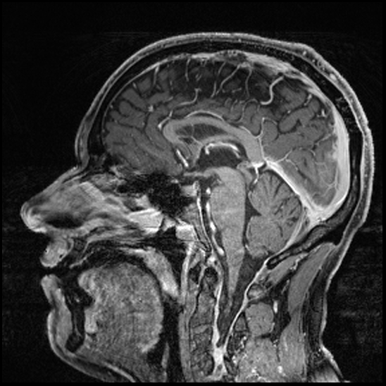 Cerebral abscess with ventriculitis (Radiopaedia 78965-91878 Sagittal T1 C+ 90).jpg