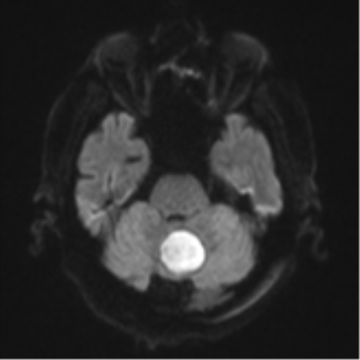Cerebral abscesses- medically managed (Radiopaedia 45183-49179 Axial DWI 37).png