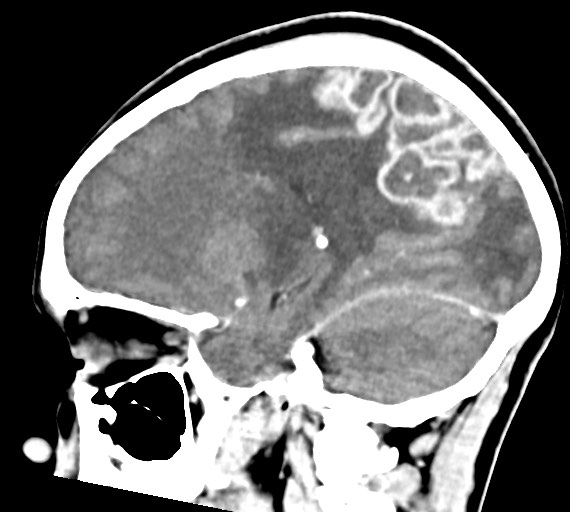 Cerebral abscesses (Radiopaedia 70458-80568 Sagittal Contrast 23).jpg
