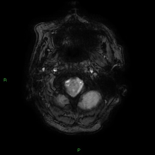 File:Cerebral amyloid angiopathy-associated lobar intracerebral hemorrhage (Radiopaedia 58376-65512 Axial SWI 1).jpg