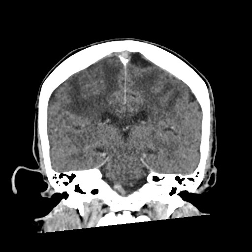 Cerebral amyloid angiopathy-related inflammation (Radiopaedia 74836-85848 Coronal non-contrast 42).jpg
