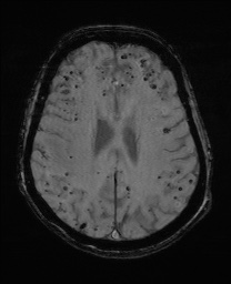Cerebral amyloid angiopathy-related inflammation (Radiopaedia 74836-85849 Axial SWI 47).jpg