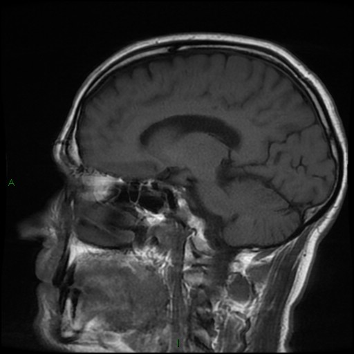 File:Cerebral amyloid angiopathy (Radiopaedia 77506-89664 Coronal T1 12).jpg