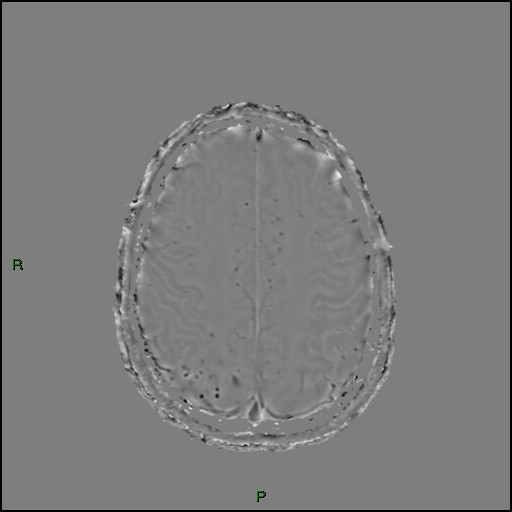 Cerebral amyloid angiopathy (Radiopaedia 77506-89664 H 78).jpg