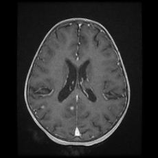 Cerebral and spinal tuberculosis (Radiopaedia 90489-107837 Axial T1 C+ 122).jpg