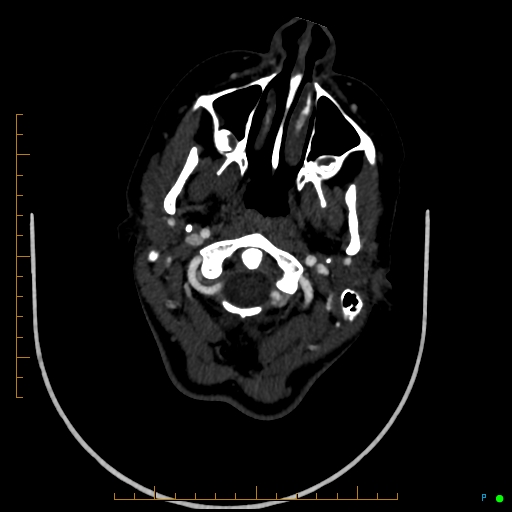 Cerebral arteriovenous malformation (AVM) (Radiopaedia 78162-90706 Axial CTA 37).jpg