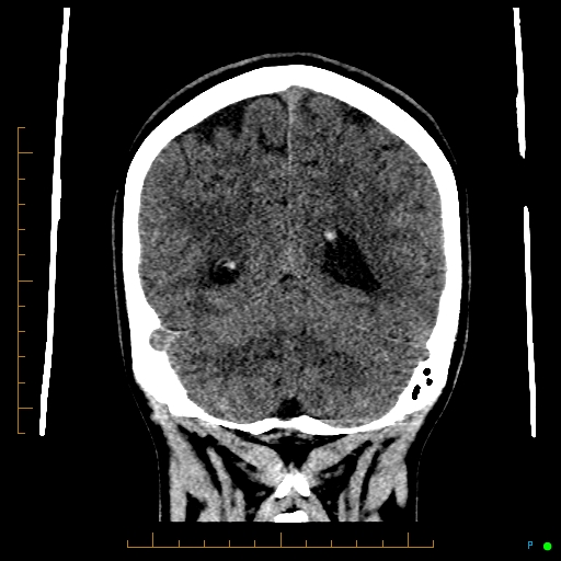 Cerebral arteriovenous malformation (AVM) (Radiopaedia 78162-90706 Coronal non-contrast 72).jpg
