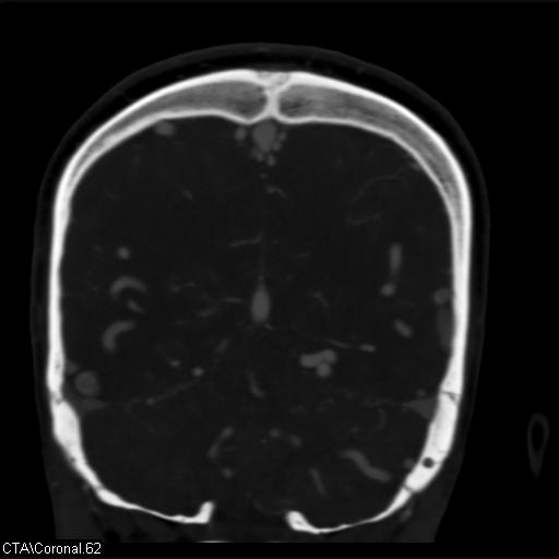 Cerebral arteriovenous malformation (Radiopaedia 28518-28759 C 62).jpg