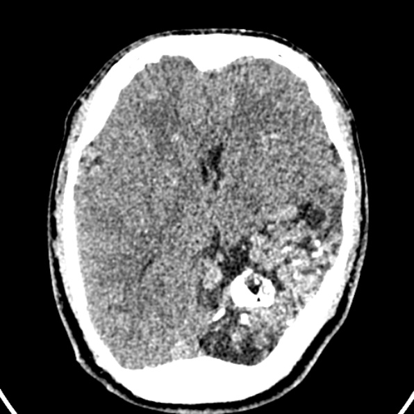 Cerebral arteriovenous malformation (Radiopaedia 37182-39012 Axial non-contrast 25).jpg