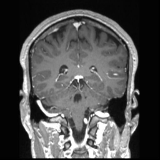 Cerebral arteriovenous malformation (Radiopaedia 39259-41506 Coronal T1 C+ 36).png