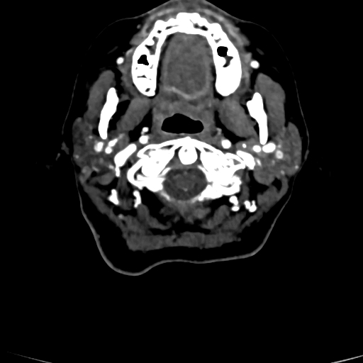Cerebral arteriovenous malformation (Radiopaedia 73830-84645 Axial C+ delayed 93).jpg